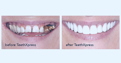 4 things to know about TeethXpress dental implants